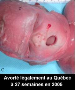 L'avortement tardif au Québec 1